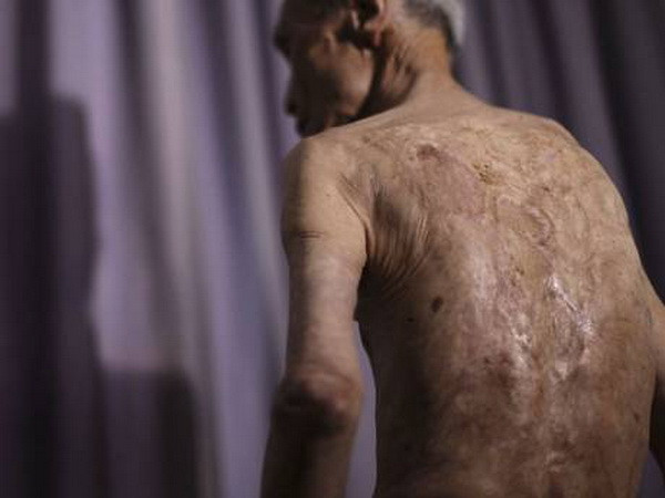 Nạn nhân bom nguyên tử ở Nagasaki kể lại những giây phút hãi hùng ảnh 1