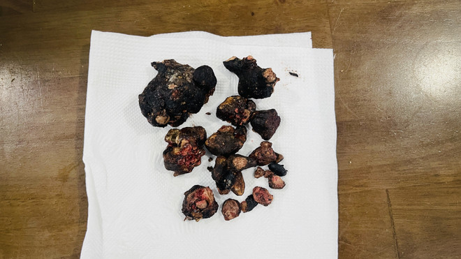 Đồng Nai: Lấy thành công khối san hô “khổng lồ” trong thận bệnh nhân ảnh 1