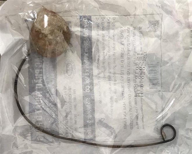 Cần Thơ: Bóc tách thành công sỏi niệu quản lớn bằng quả trứng gà ảnh 1