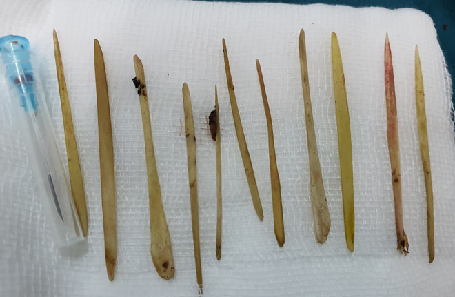 Phẫu thuật lấy ra 11 que tăm xỉa răng trong ruột non một bệnh nhân nam ảnh 1