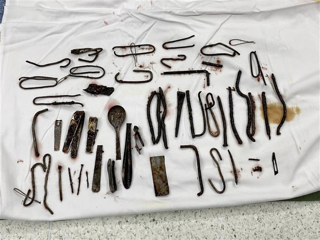 Phẫu thuật lấy ra khoảng 1kg kim loại trong bụng một bệnh nhân ảnh 1