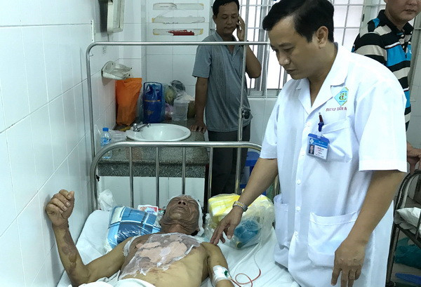 Đi ăn cỗ cưới, 8 người bị bỏng nặng vì bếp cồn bắt lửa ảnh 1