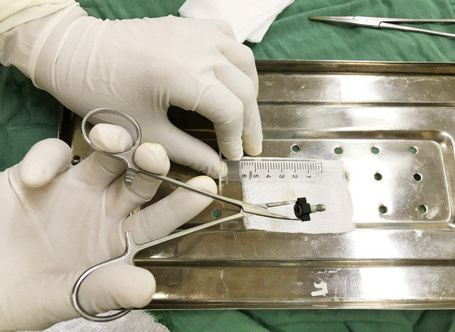 Bạc Liêu: Khẩn cấp lấy dị vật thành công trong âm đạo bé gái 8 tuổi ảnh 1