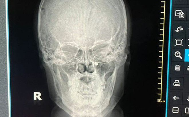 Phú Thọ: Gắp thành công viên bi sắt trong mũi bé trai 4 tuổi ảnh 1