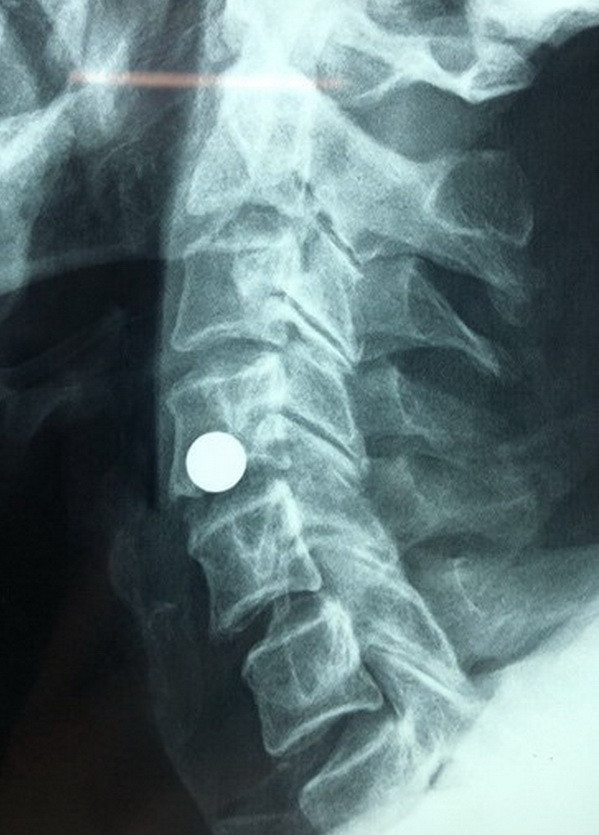 Cần Thơ: Cứu sống bệnh nhân bị đạn bi găm vào cột sống cổ ảnh 2