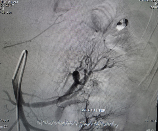 Cần Thơ: Cứu sống bệnh nhân nguy kịch do xuất huyết tiêu hóa hiếm gặp ảnh 2