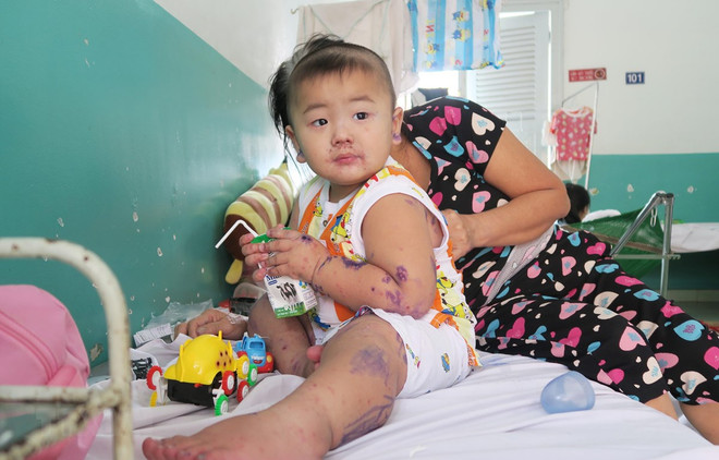 Không thiếu thuốc thay thế để điều trị bệnh tay chân miệng thể nặng ảnh 1