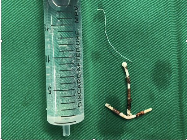 Vòng tránh thai "đi lạc" vào trong bàng quang bệnh nhân 40 tuổi ảnh 1