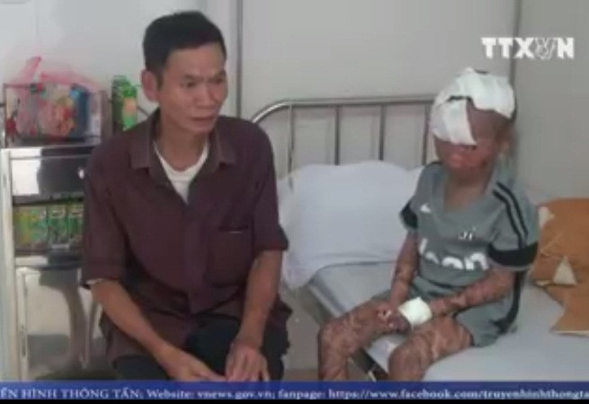 Yên Bái: Phát hiện bệnh nhân bị vảy cá bẩm sinh hiếm gặp ảnh 1