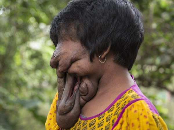 Cảm phục tinh thần lạc quan của cô gái Ấn Độ không có khuôn mặt ảnh 1