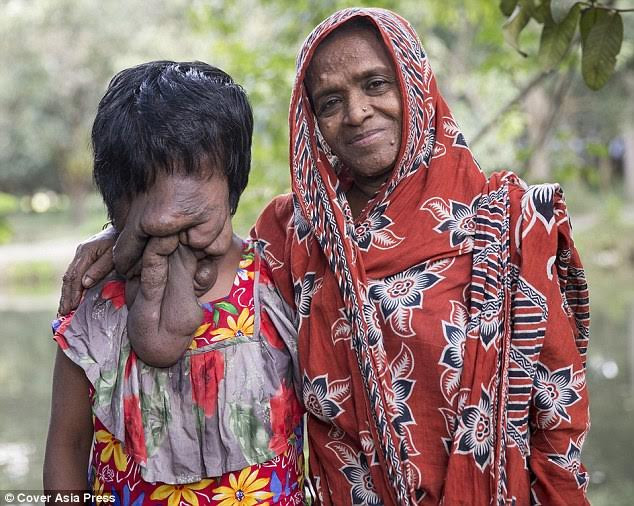 Cảm phục tinh thần lạc quan của cô gái Ấn Độ không có khuôn mặt ảnh 2