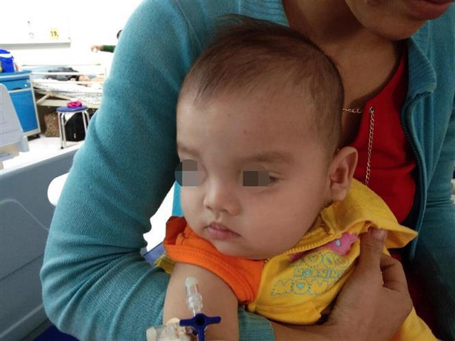 Phẫu thuật khối bướu khổng lồ trên mặt cho bệnh nhi 12 tháng tuổi ảnh 1