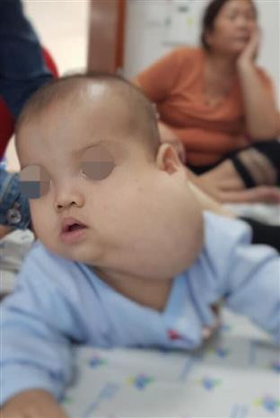 Phẫu thuật khối bướu khổng lồ trên mặt cho bệnh nhi 12 tháng tuổi ảnh 2