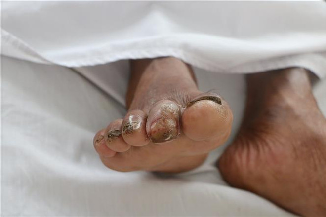 Bệnh nhân H có tiền sử bị bệnh đái tháo đường type II, biến chứng loét ngón 2 bàn chân phải mà vẫn làm việc đồng áng và tiếp xúc với bùn đất mà không có phương tiện bảo hộ nên đã bị vi khuẩn Burkholderia pseudomallei xâm nhập qua vết loét mà không biết. (Ảnh: TTXVN) Hà Tĩnh phát hiện một bệnh nhân nhiễm bệnh Whitmore ảnh 1