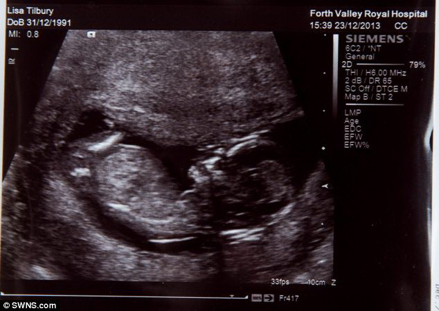 Quyết sinh con dù thai nhi chỉ có 1% cơ hội sống sót ảnh 2