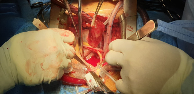 Cần Thơ: Cứu sống bệnh nhân bị u tim, khối u bằng quả trứng vịt ảnh 1