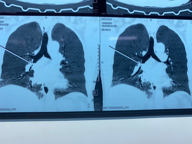 Gắp mảnh xương nằm hơn một tháng trong phế quản của bệnh nhân ảnh 1