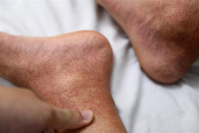 Số ca mắc sốt xuất huyết tiếp tục tăng, nhiều bệnh nhân chuyển nặng ảnh 1