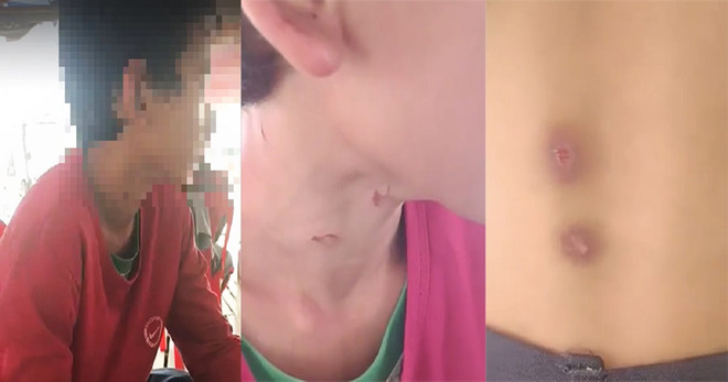 An Giang: Một bé trai 14 tuổi nghi bị bố dượng bạo hành dã man ảnh 1