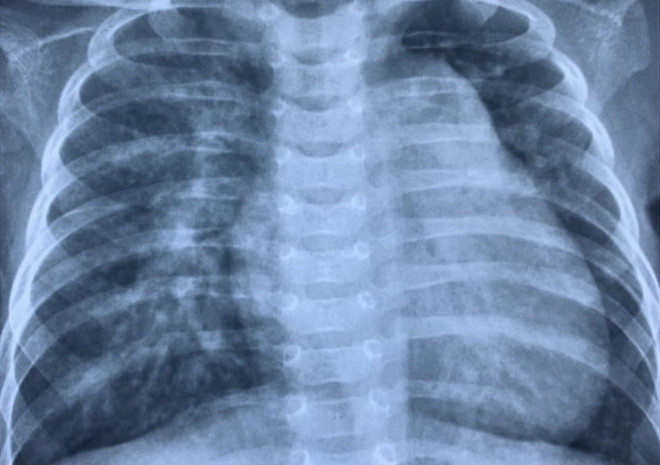 Ứng dụng thành công kỹ thuật Hybrid cho ca bệnh nhỏ tuổi nhất Việt Nam ảnh 1