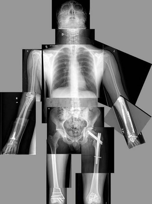 Phẫu thuật tái tạo hộp sọ bệnh nhân bằng công nghệ in 3D ảnh 2