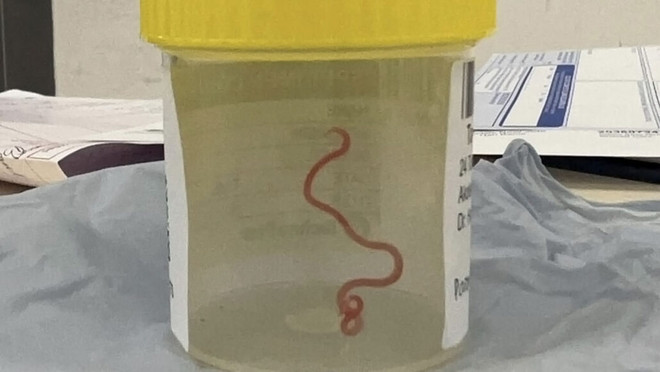 Con giun trong não bệnh nhân. (Nguồn: ScienceNews) Giun dài 8cm ký sinh trong não khiến bệnh nhân "đãng trí và trầm cảm" ảnh 1