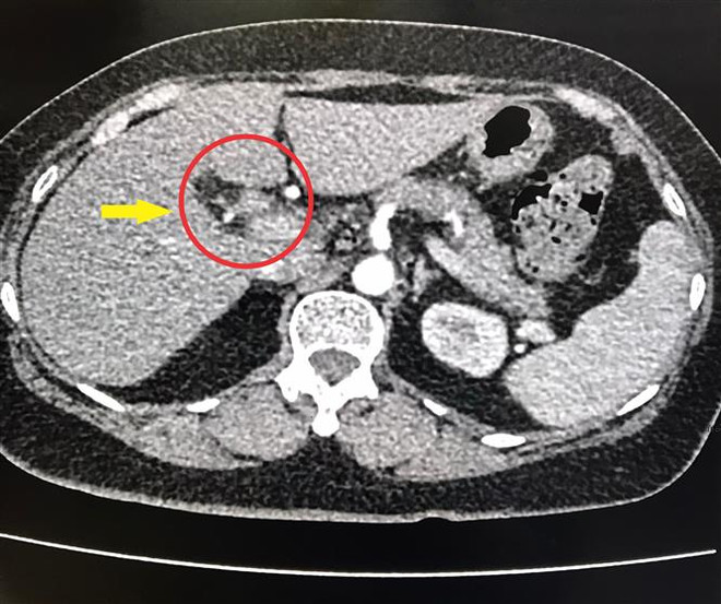 Bạc Liêu: Can thiệp thành công trường hợp tắc đường mật hiếm gặp ảnh 1