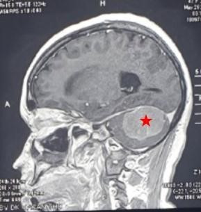 Hình chụp MRI khối u trước phẫu thuật. (Ảnh: TTXVN phát) Cần Thơ: Phẫu thuật bóc tách thành công khối u não ở vị trí hiếm gặp ảnh 2