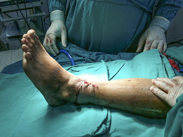 Điện Biên: Nối thành công phần chân bị cắt đứt rời hoàn toàn ảnh 1