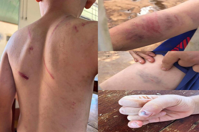Cơ thể cháu A. chằng chịt vết thương. (Nguồn: baogiaothong.vn) Vụ cháu bé 9 tuổi bị đánh đập ở Đắk Lắk: Khởi tố bà nội và cha ruột ảnh 1