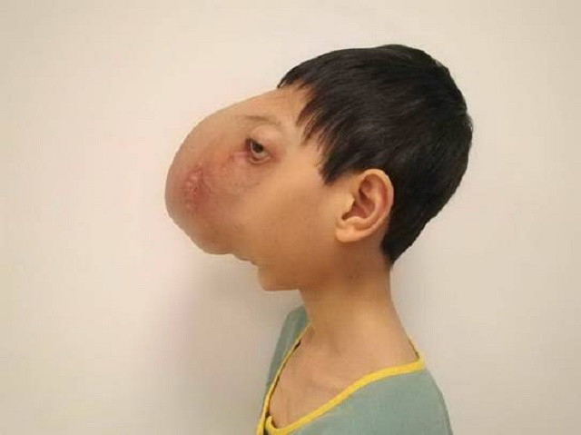 Em Lê Trung Tuấn từng bị khối u che hết khuôn mặt và bị ảnh hưởng tới khả năng nghe, nhìn Giáo sư Mỹ mang điều kỳ diệu đến với cậu bé “không có mặt” ảnh 2