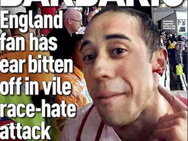 Một cổ động viên Anh bị cắn đứt tai trong trận đấu với Uruguay ảnh 1