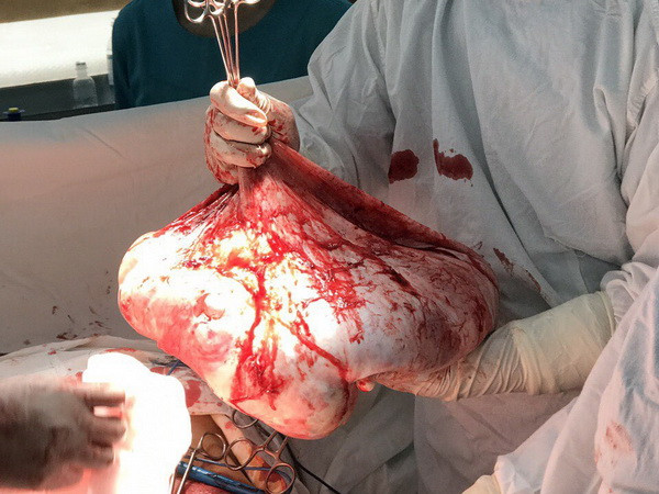 Bóc tách thành công khối u buồng trứng nặng 35kg trong bụng ảnh 1