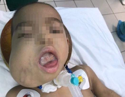 Bệnh nhi có khối u quái vùng má bên phải từ lúc 4 tháng tuổi và lớn lên từng ngày. (Ảnh: Mai Trang/TTXVN) Phẫu thuật thành công cho bệnh nhi mắc khối u quái hỗn hợp vùng mặt ảnh 1