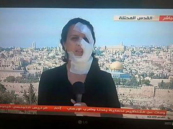 Nữ phóng viên vẫn lên sóng dù trúng mảnh lựu đạn Israel vào mặt ảnh 1