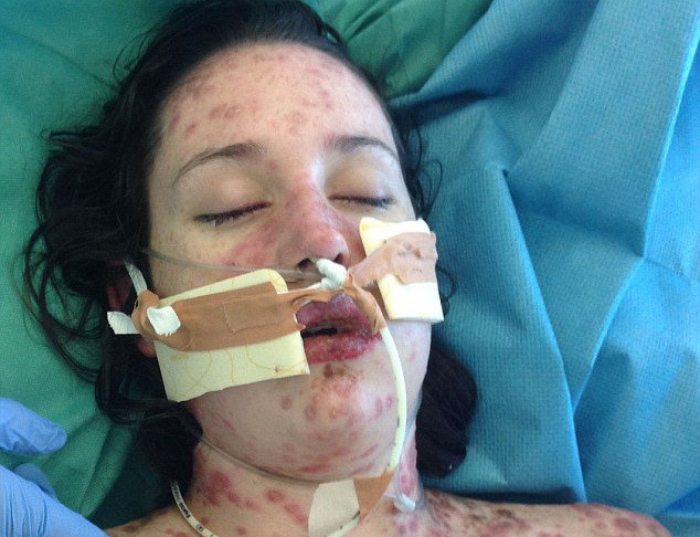 Suýt mất mạng vì dị ứng với thuốc điều trị bệnh động kinh ảnh 3