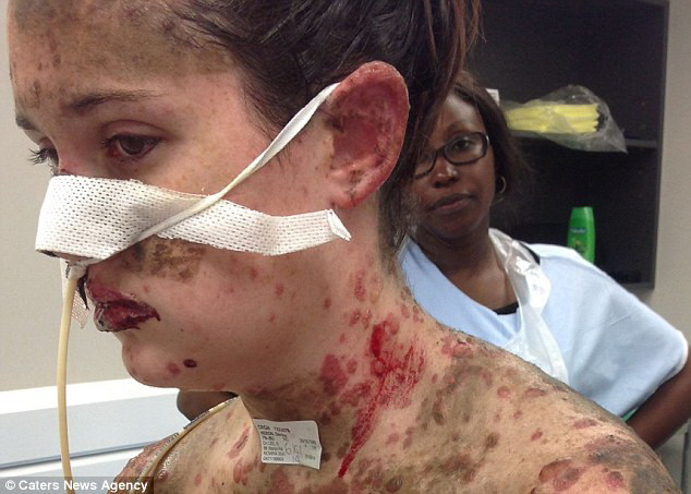 Suýt mất mạng vì dị ứng với thuốc điều trị bệnh động kinh ảnh 2