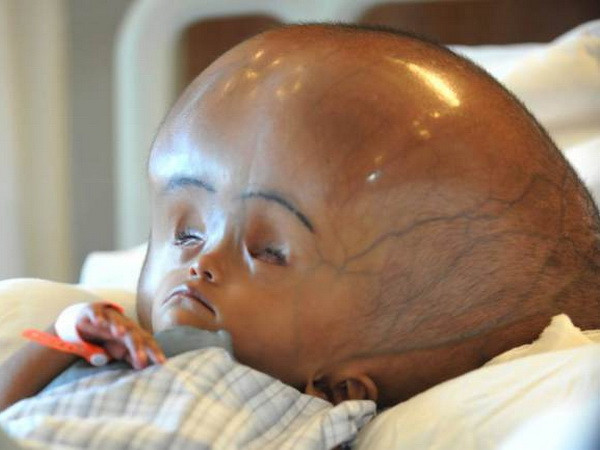 Bé gái suýt tử vong vì cái đầu khổng lồ đã hồi phục kỳ diệu ảnh 1