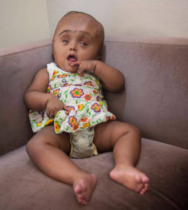 Bé gái suýt tử vong vì cái đầu khổng lồ đã hồi phục kỳ diệu ảnh 2