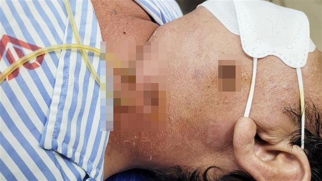 Bạc Liêu: Phẫu thuật cứu kịp thời bệnh nhân bị áp xe vùng cổ nguy hiểm ảnh 1