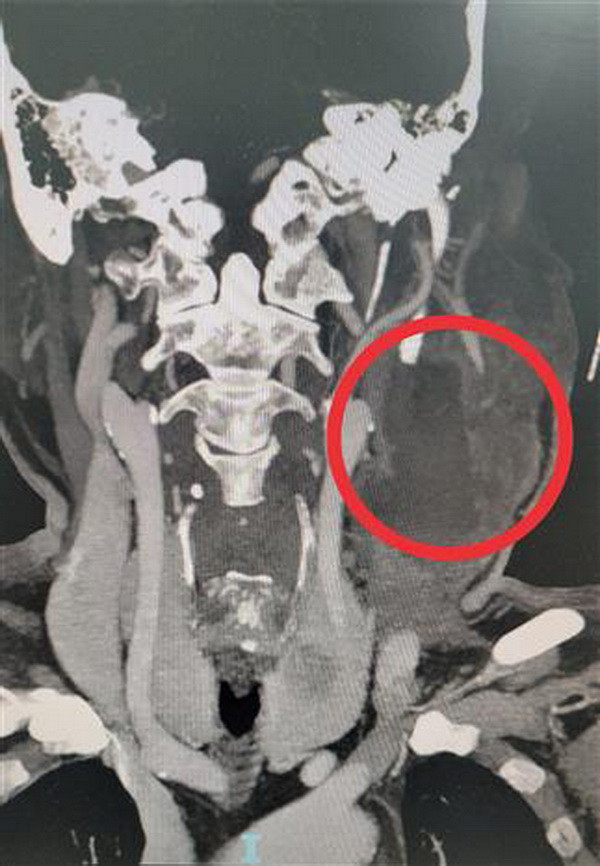 Bạc Liêu: Phẫu thuật cứu kịp thời bệnh nhân bị áp xe vùng cổ nguy hiểm ảnh 2