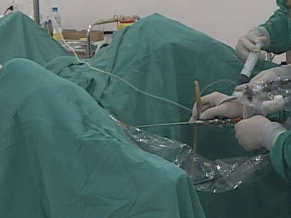 Hi hữu ca thủng ruột non do thói quen ngậm tăm xỉa răng ảnh 1