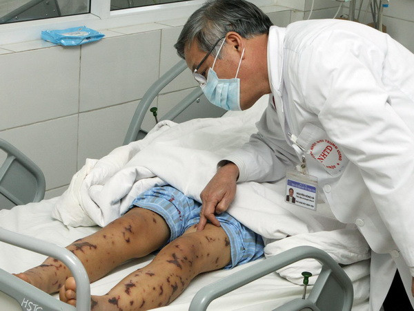 Một bé trai 5 tháng tuổi ở Đắk Lắk bị bệnh viêm não mô cầu ảnh 1