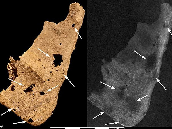 Phát hiện dấu vết bệnh ung thư ở hài cốt 3.200 năm tuổi ảnh 1