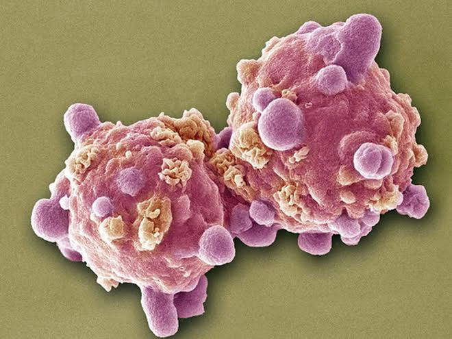 Những dấu hiệu ban đầu của bệnh ung thư thường bị làm ngơ ảnh 1