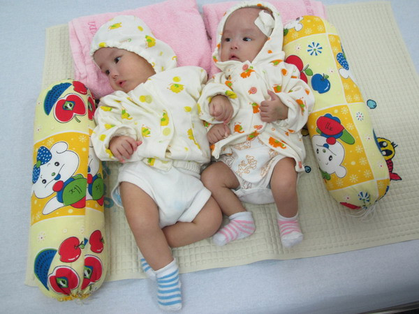 Phẫu thuật thành công cặp song sinh dính liền phần ngực ảnh 1