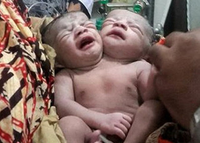 Hàng ngàn người hiếu kỳ kéo đến xem bé hai đầu ở Bangladesh ảnh 1