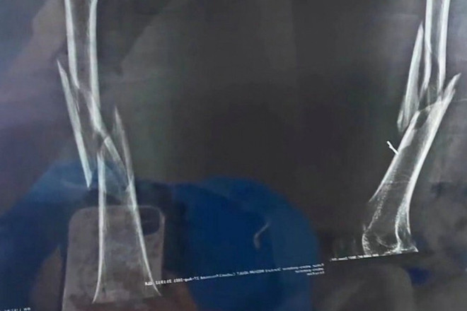 Người phụ nữ gãy xương đùi, mất khả năng đi vì tập yoga sai tư thế ảnh 1