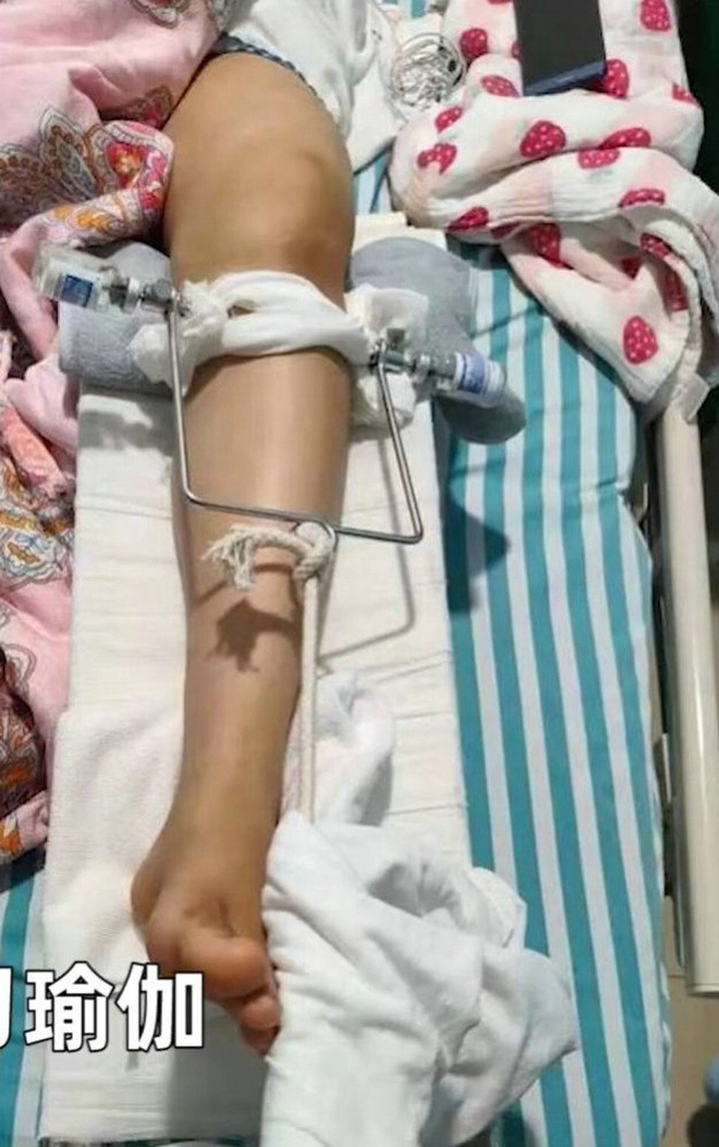 Người phụ nữ gãy xương đùi, mất khả năng đi vì tập yoga sai tư thế ảnh 2