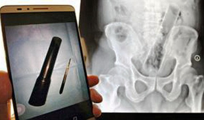 Bác sỹ sửng sốt khi phát hiện vật thể lạ 25cm gần ruột kết bệnh nhân ảnh 1